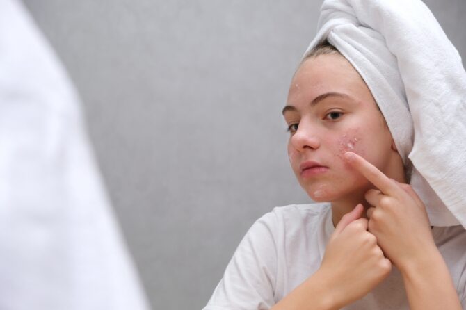 Here’s What’s Being Touted as the #1 Acne Treatment in Rockville, Maryland