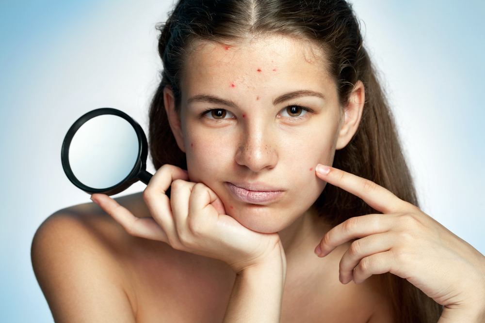 AviClear Acne Treatment in Rockville MD