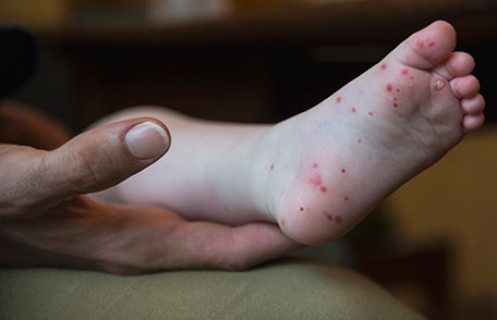 Hand, Foot, and Mouth Disease – Info You Should Know