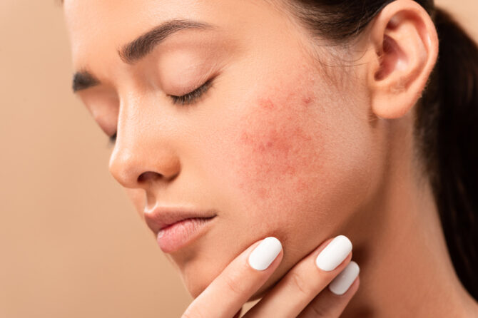 Here’s Why AviClear Is the Best Non-Accutane Acne Treatment in Rockville