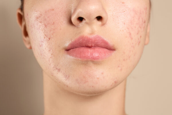 Here’s Why the Best Hormonal Acne Treatment Doctor in Bethesda Recommends AviClear!