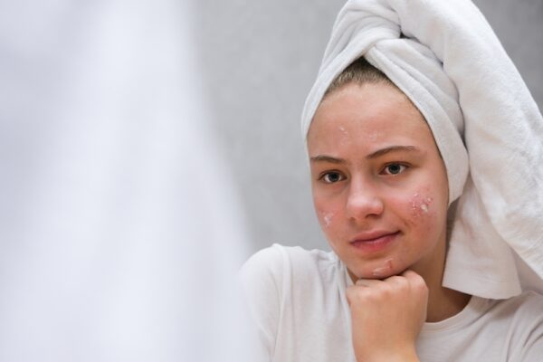 Speak to Your Provider About AviClear During a Same-Day Acne Visit in Rockville, Maryland