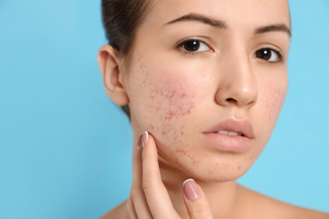 When Is It Time to See the Best Teenage Acne Doctor in Chevy Chase, Maryland?