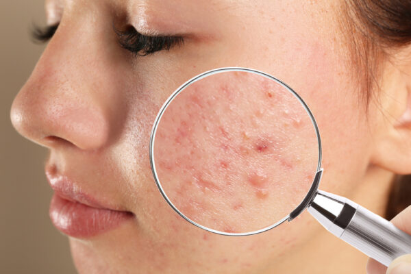 Acne Specialist in Potomac: 4 Signs to Make an Appointment for Your Child