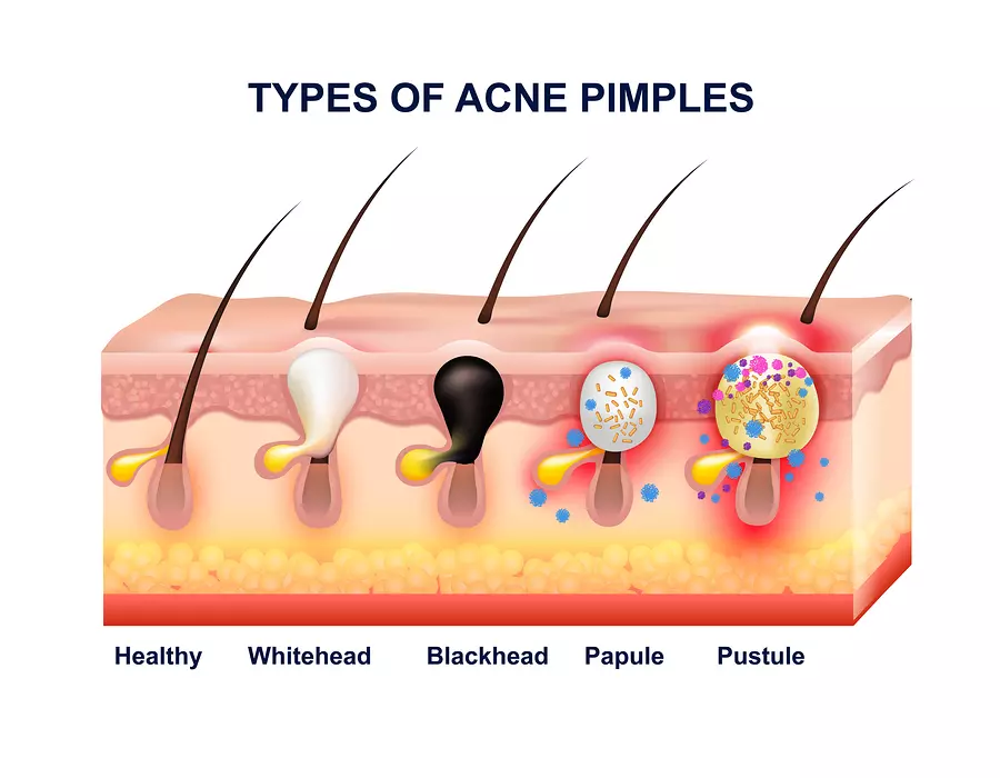 Acne Clinic