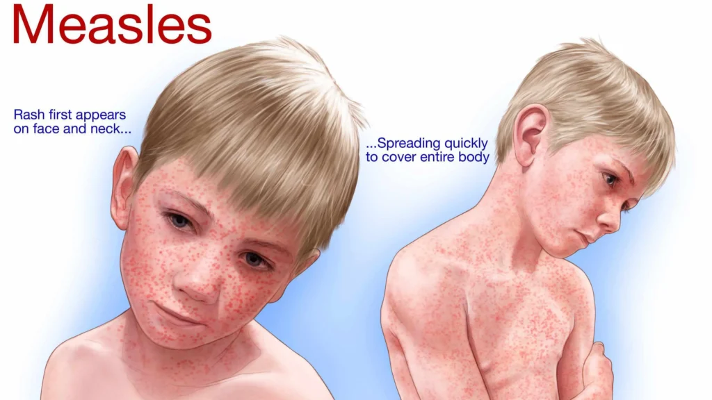 Measles in the news