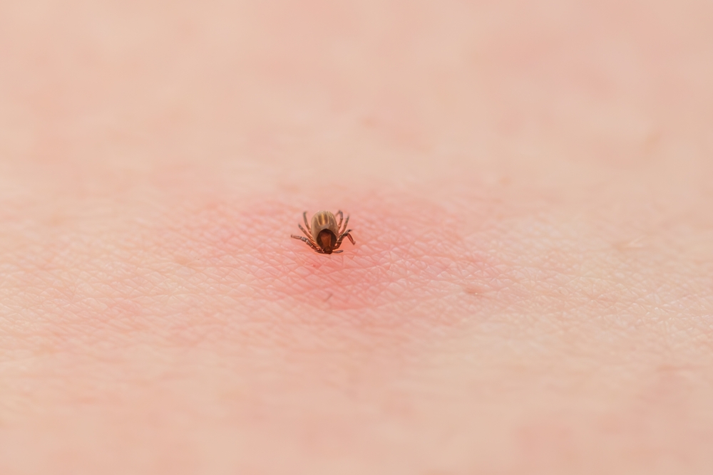 tick bites Rockville Maryland